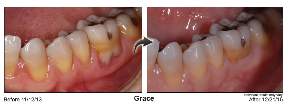 fix gum recession Winchester Virginia